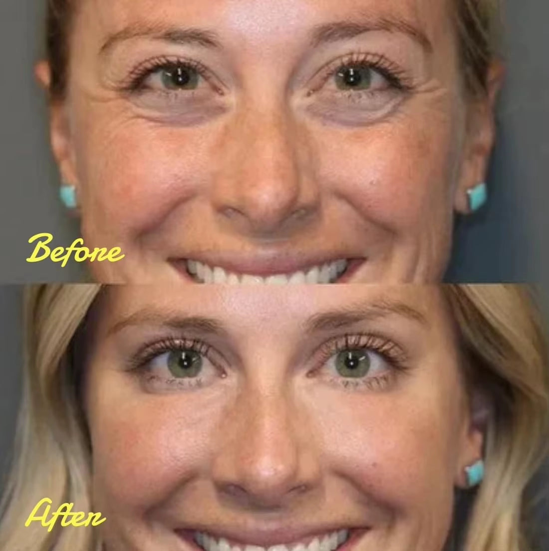 Instant Firm Eye Tightener, Eye Cream, Eye Firming Agent, Eye Lifting, Firming, Removing Eye Bags, Wrinkle Removal, and Eye Care